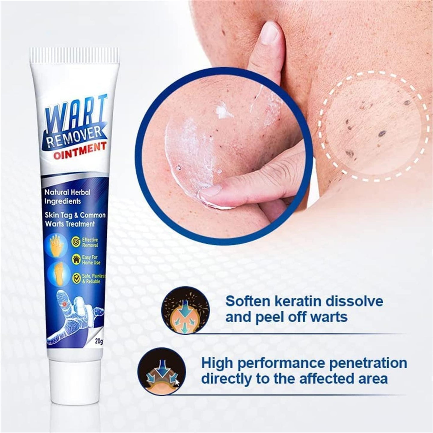 Instant Wart Remover (Buy 1 Get 1 Free)